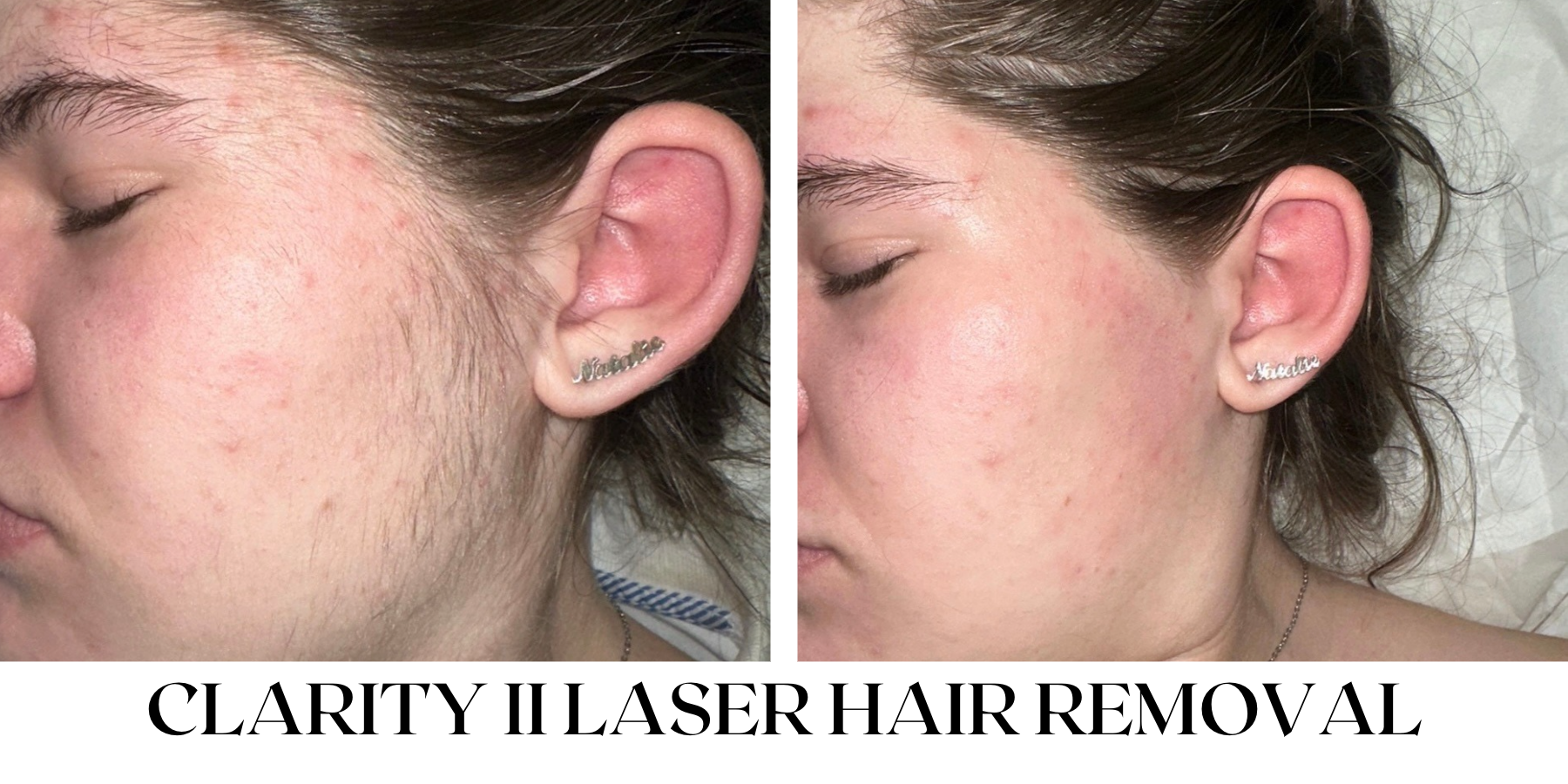 Before and After — Julia's Skin Care & Spa